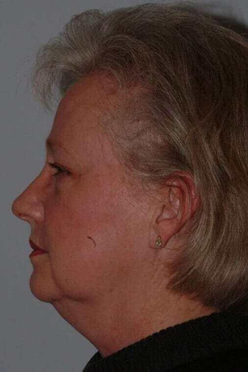 Facelift Before & After Patient #5424