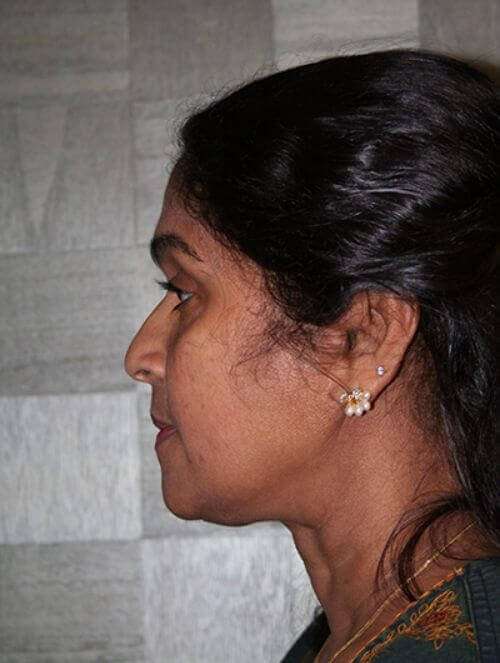Facelift Before & After Patient #5431