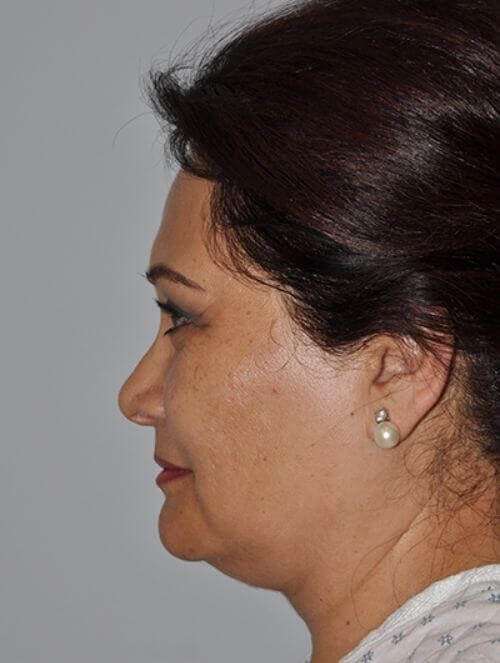 Facelift Before & After Patient #5438