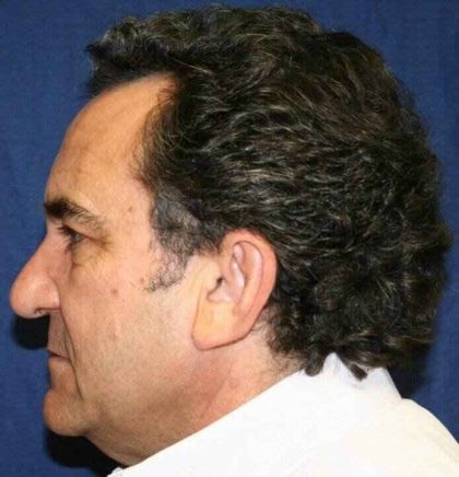 Facelift Before & After Patient #5452