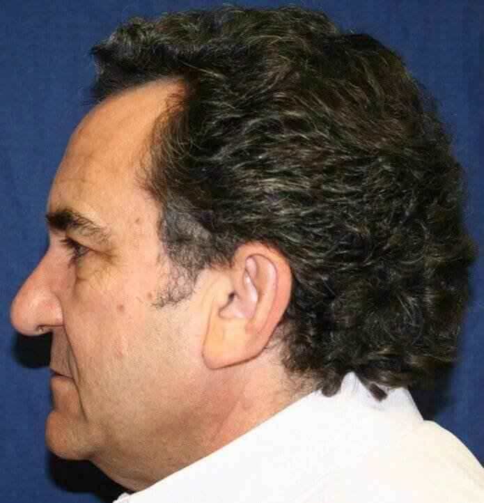 Facelift Before & After Patient #5452