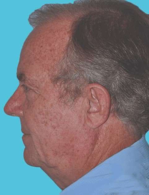 Facelift Before & After Patient #5459