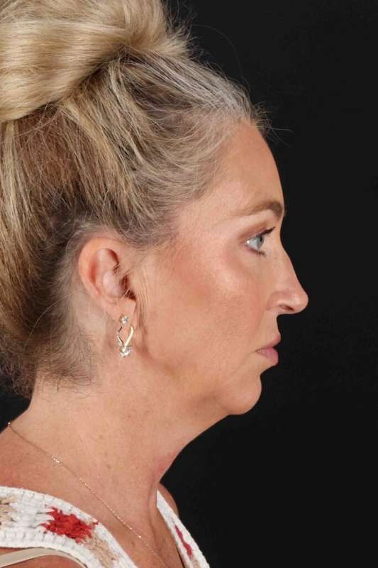 Facelift Before & After Patient #5488