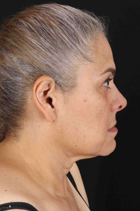Facelift Before & After Patient #5510