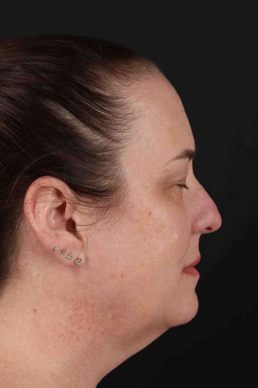 Facelift Before & After Patient #5521