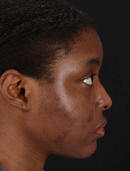 Chemical Peels Before & After Patient #5568