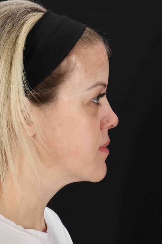 Chemical Peels Before & After Patient #5601