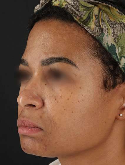 Chemical Peels Before & After Patient #5610