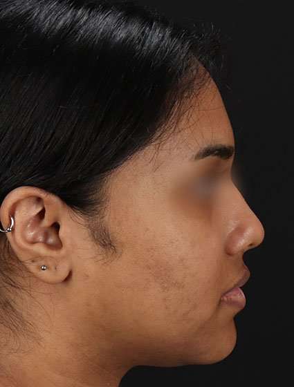 Chemical Peels Before & After Patient #5621