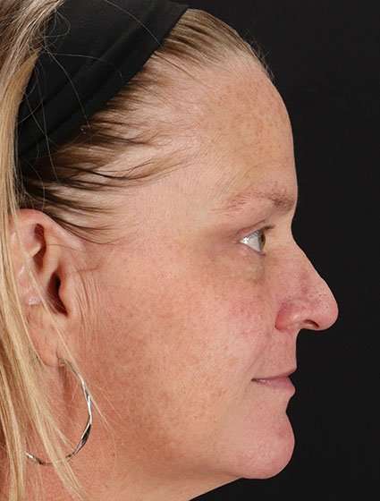 Chemical Peels Before & After Patient #5632