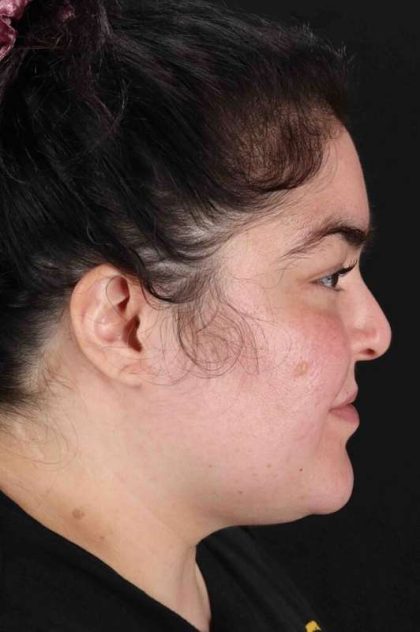 Neck Liposuction Before & After Patient #5643