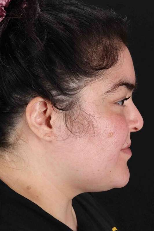 Neck Liposuction Before & After Patient #5643