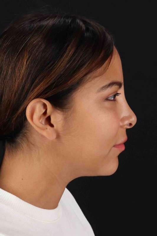 Neck Liposuction Before & After Patient #5654