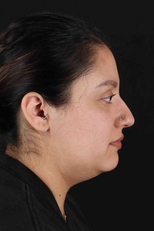 Neck Liposuction Before & After Patient #5665