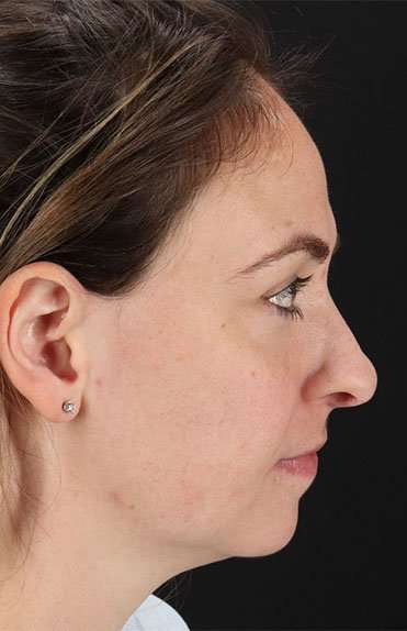 Neck Liposuction Before & After Patient #5687