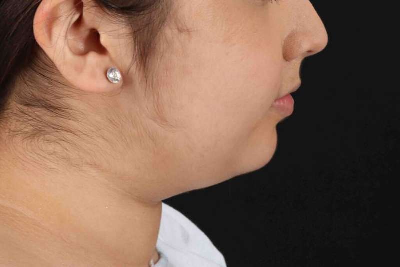 Neck Liposuction Before & After Patient #5698