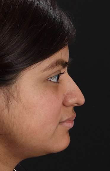 Neck Liposuction Before & After Patient #5709