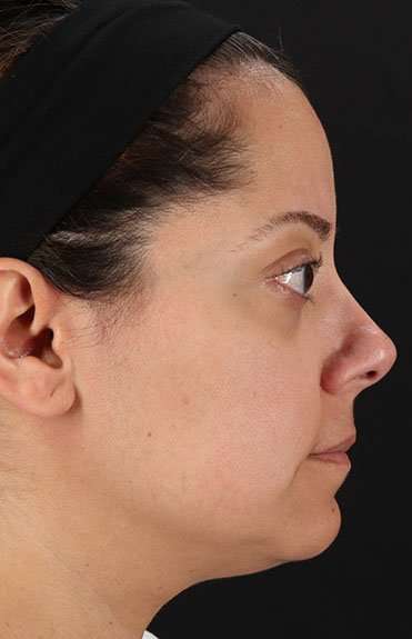Neck Liposuction Before & After Patient #5720