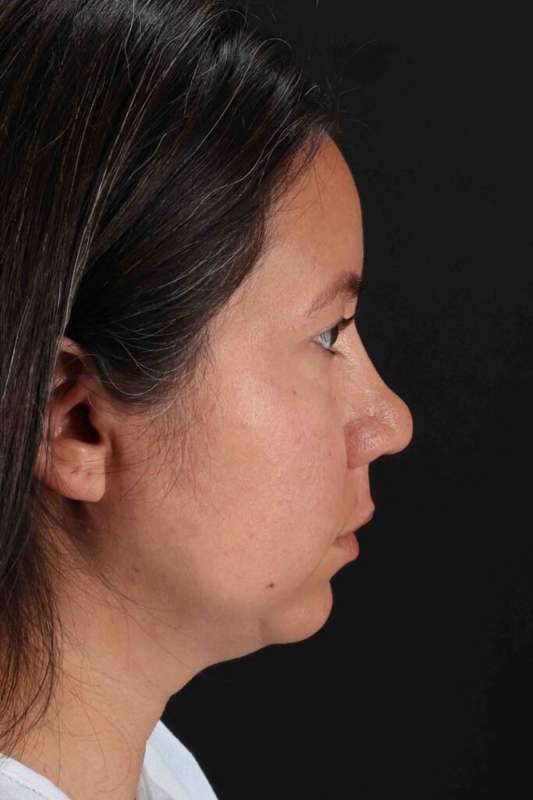 Neck Liposuction Before & After Patient #5731
