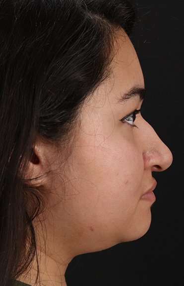 Neck Liposuction Before & After Patient #5742