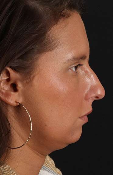 Neck Liposuction Before & After Patient #5753