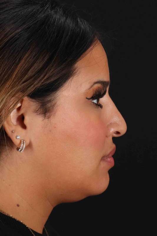 Neck Liposuction Before & After Patient #5762