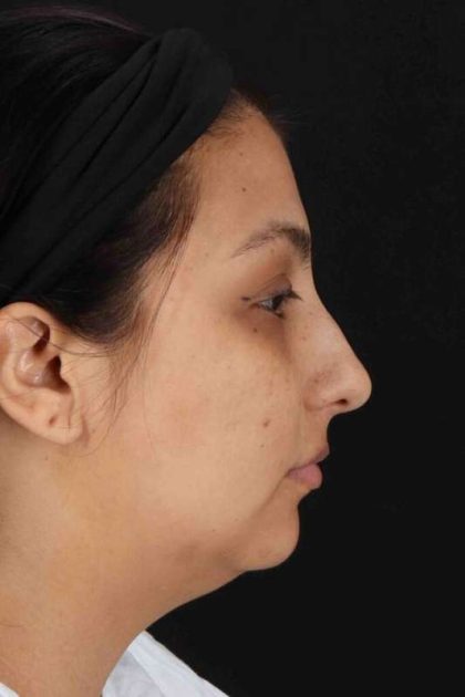 Rhinoplasty Before & After Patient #5826