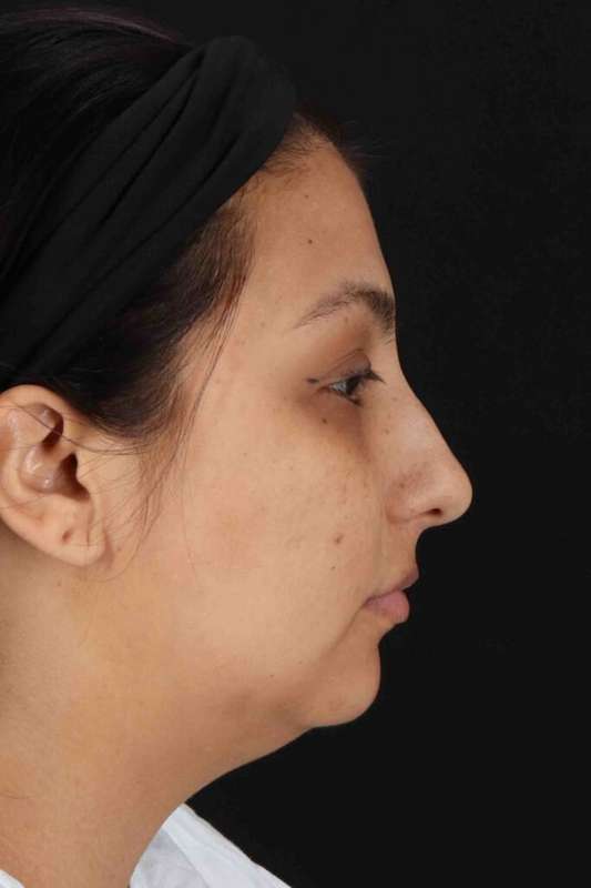 Rhinoplasty Before & After Patient #5826