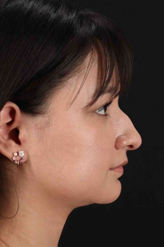 Rhinoplasty Before & After Patient #5837