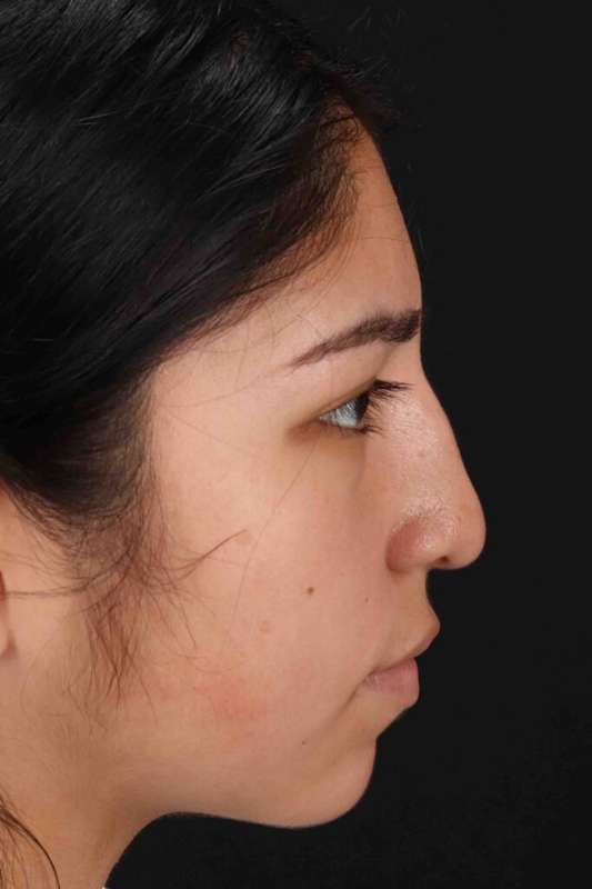 Rhinoplasty Before & After Patient #5848