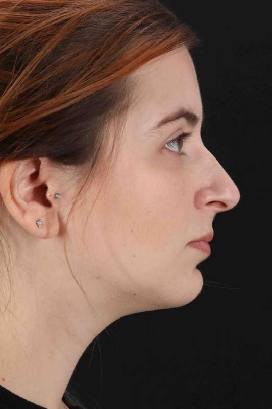 Rhinoplasty Before & After Patient #5859
