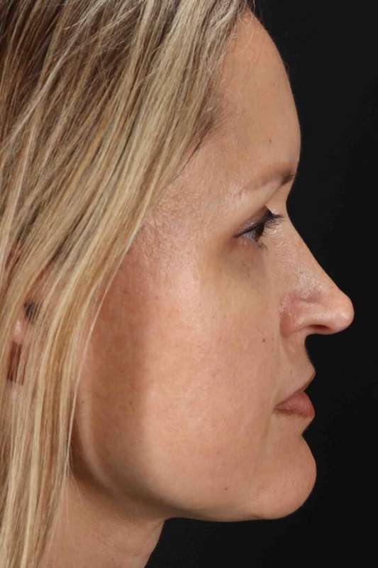 Rhinoplasty Before & After Patient #5870