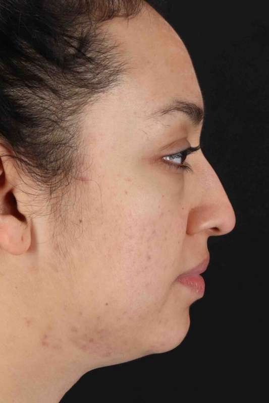 Rhinoplasty Before & After Patient #5881