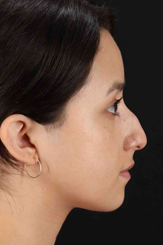Rhinoplasty Before & After Patient #5892