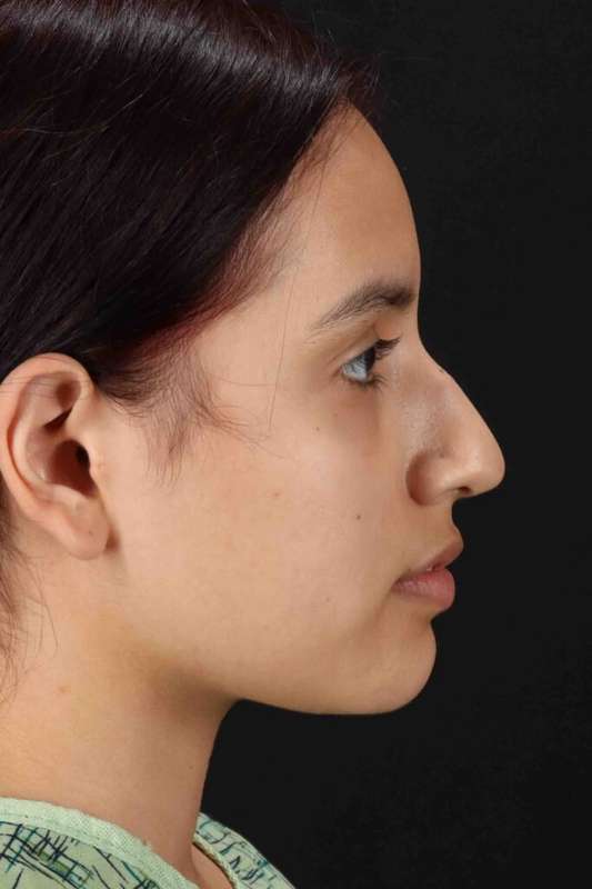 Rhinoplasty Before & After Patient #5903