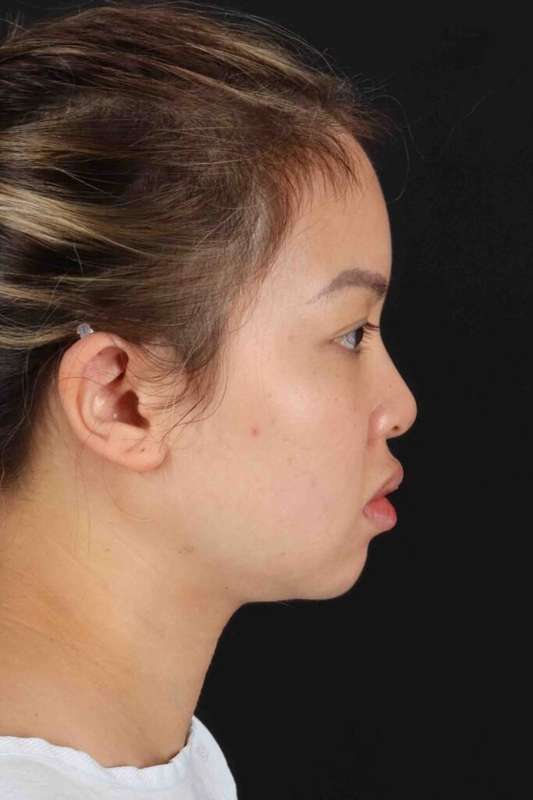 Rhinoplasty Before & After Patient #5914