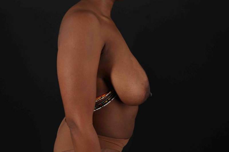Abdominoplasty (Tummy Tuck) Before & After Patient #1099