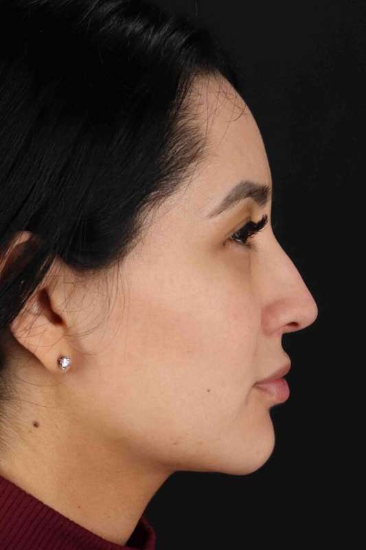 Rhinoplasty Before & After Patient #5925