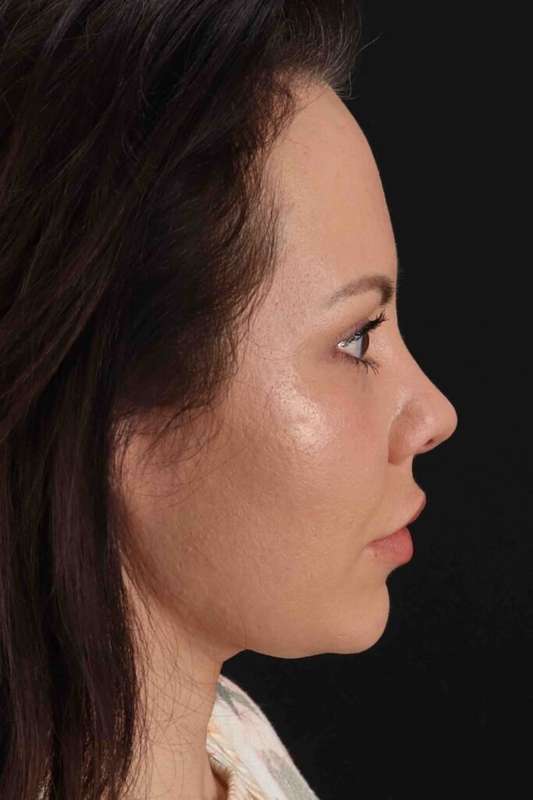Rhinoplasty Before & After Patient #5936