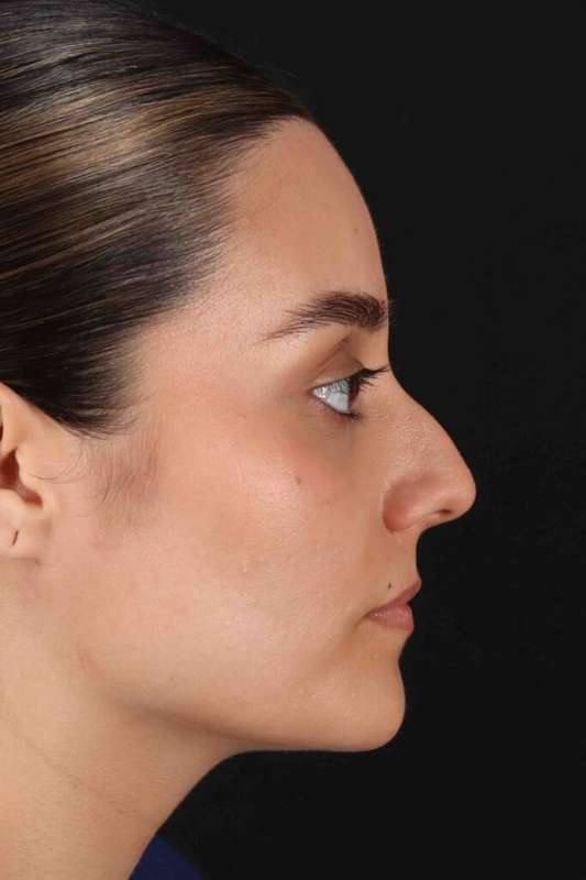 Rhinoplasty Before & After Patient #5947