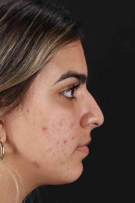 Rhinoplasty Before & After Patient #5958