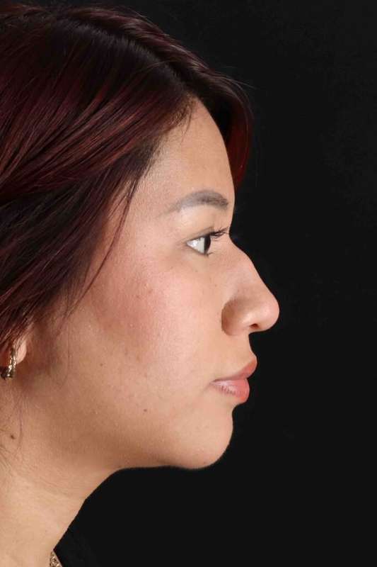 Rhinoplasty Before & After Patient #5983