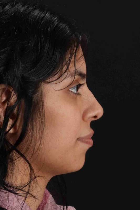 Rhinoplasty Before & After Patient #5994