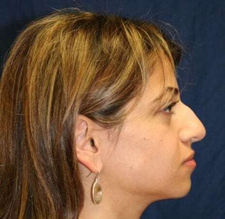 Rhinoplasty Before & After Patient #6021
