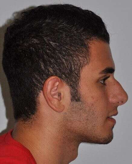 Rhinoplasty Before & After Patient #6028
