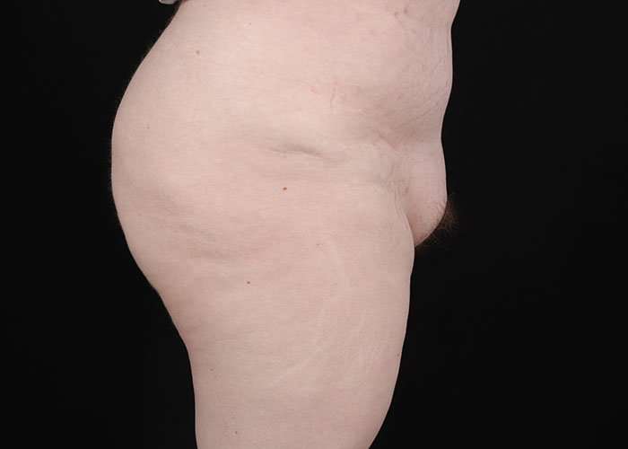 Monsplasty Before & After Patient #1117