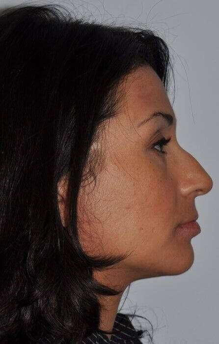 Rhinoplasty Before & After Patient #6035