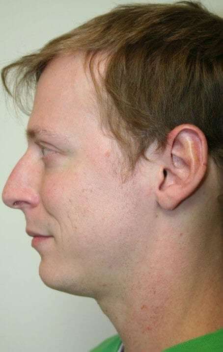 Rhinoplasty Before & After Patient #6047