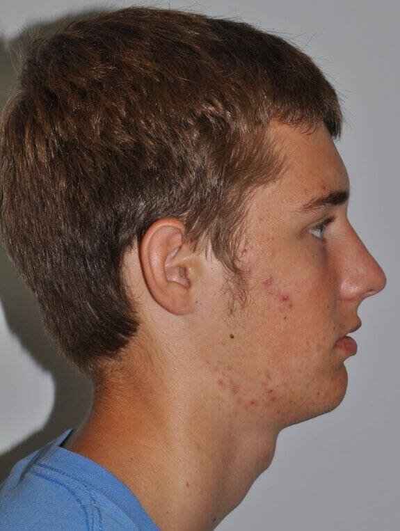 Rhinoplasty Before & After Patient #6061