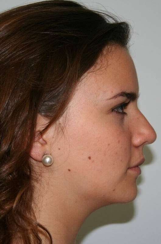 Rhinoplasty Before & After Patient #6075